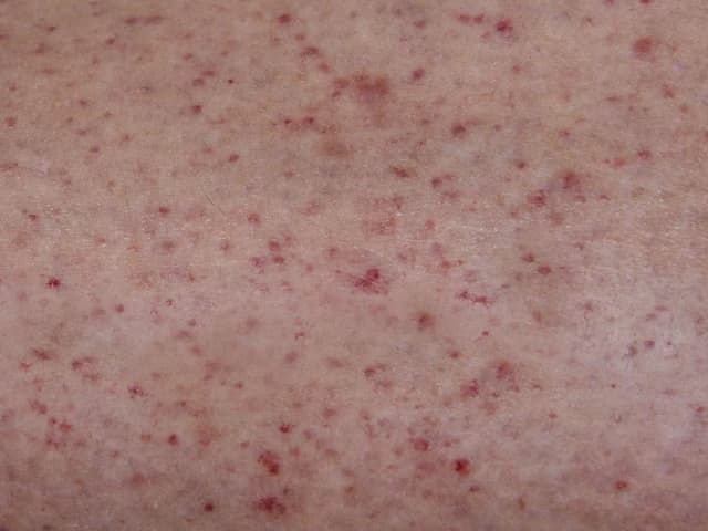 Sepsa: jakie badania są kluczowe dla szybkiej diagnozy i ratunku? Sepsa: jakie badania są kluczowe dla szybkiej diagnozy i ratunku?