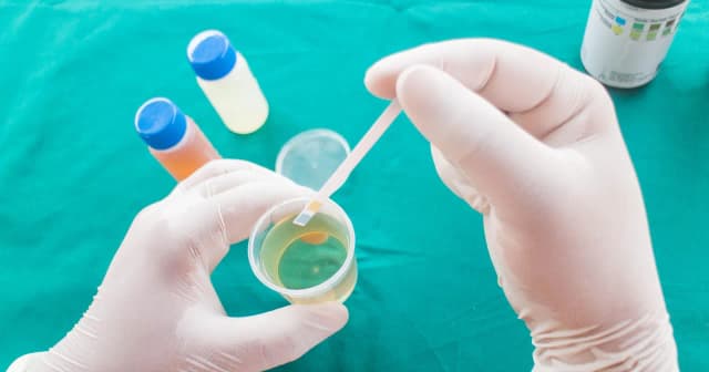 Ile moczu wystarczy do badania? Sprawdź, by uniknąć błędów Ile moczu wystarczy do badania? Sprawdź, by uniknąć błędów