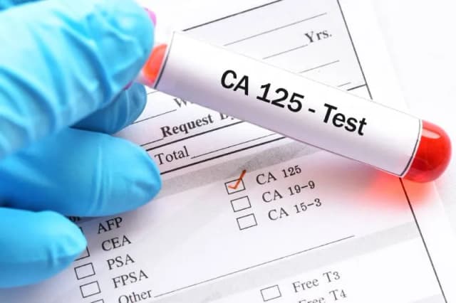 Podwyższony poziom CA 125: Dlaczego warto znać jego znaczenie w diagnostyce Podwyższony poziom CA 125: Dlaczego warto znać jego znaczenie w diagnostyce