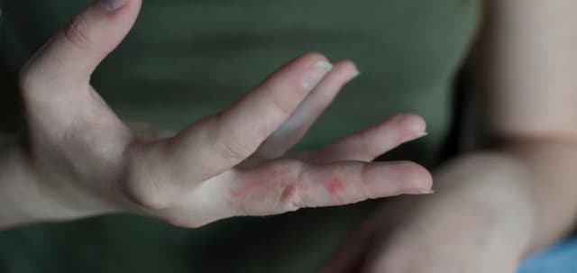 Jakie leki na świerzb skutecznie eliminują objawy i pasożyty? Jakie leki na świerzb skutecznie eliminują objawy i pasożyty?