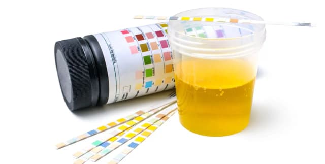 Jak przygotować się do badania moczu, by wyniki były wiarygodne? Jak przygotować się do badania moczu, by wyniki były wiarygodne?